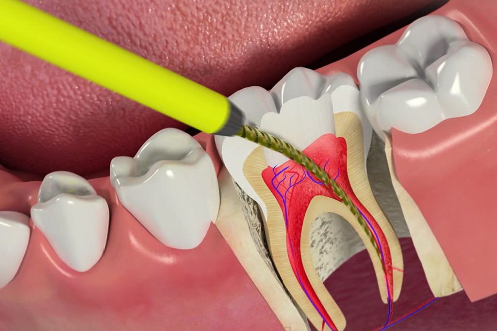 endodontia-3