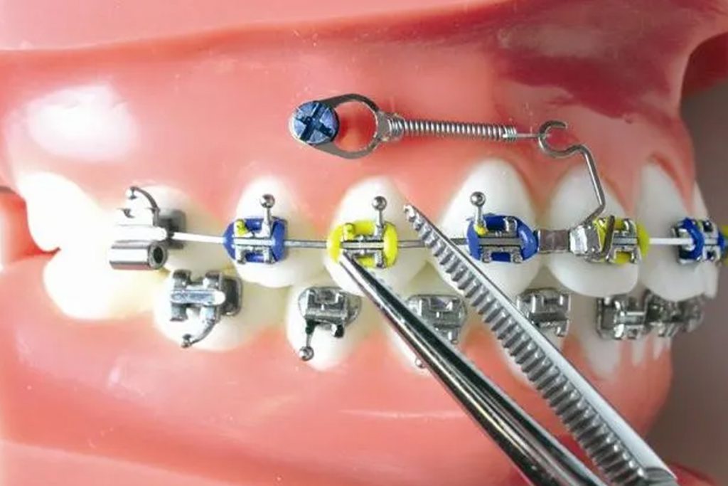 mini-implantes-2