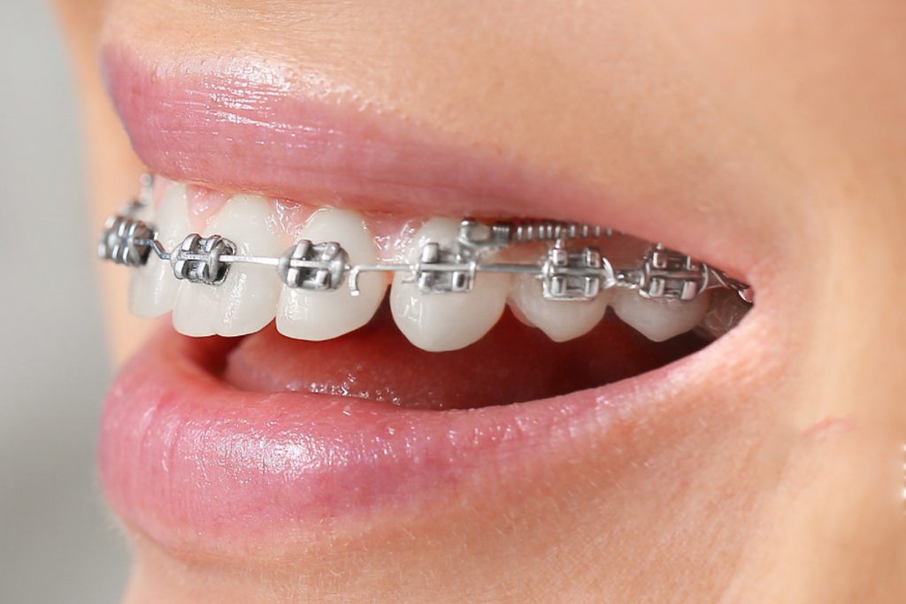 mini-implantes-3
